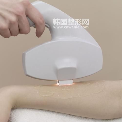 无痛冰点脱毛