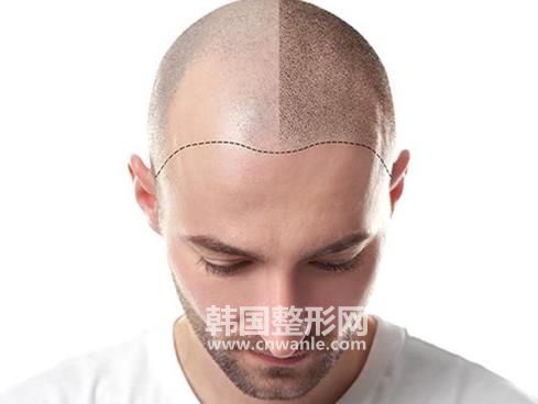 <a href='/tag_maofayizhi6.html'>毛发移植</a>术对身体有什么危害?