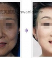 玻尿酸丰脸颊效果如何_1