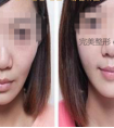 玻尿酸丰面颊到底效果如何