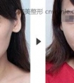 玻尿酸丰面颊会不会反弹呢?