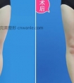 湘潭腿部吸脂后会反弹吗