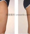 福州腿部吸脂减肥会反弹吗? (2)