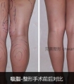 济宁腿部吸脂会反弹吗