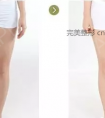 大腿抽脂会反弹吗?有哪些注意事项?