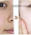 冰点脱毛的副作用