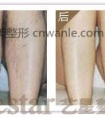 成都激光脱腿毛会痛吗