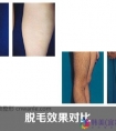 冰点脱毛优势是什么
