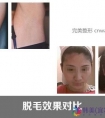 冰点脱毛的优势有哪些?冰点脱毛