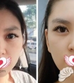 做电波拉皮除皱后反弹更显老?我用个人经历解析这是为啥...