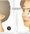 长春哪家医院做拉皮好?电波拉皮的效果、价格及优势