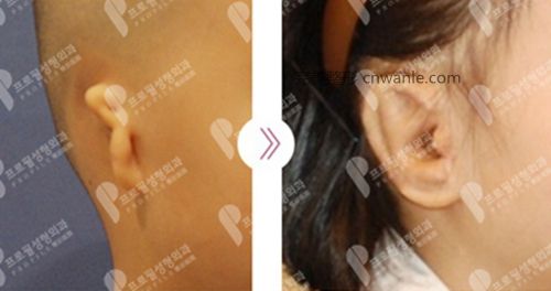 韩国profile普罗菲耳整形医院花生耳矫正案例