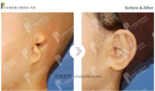 韩国profile普罗菲耳整形医院小耳症矫正案例