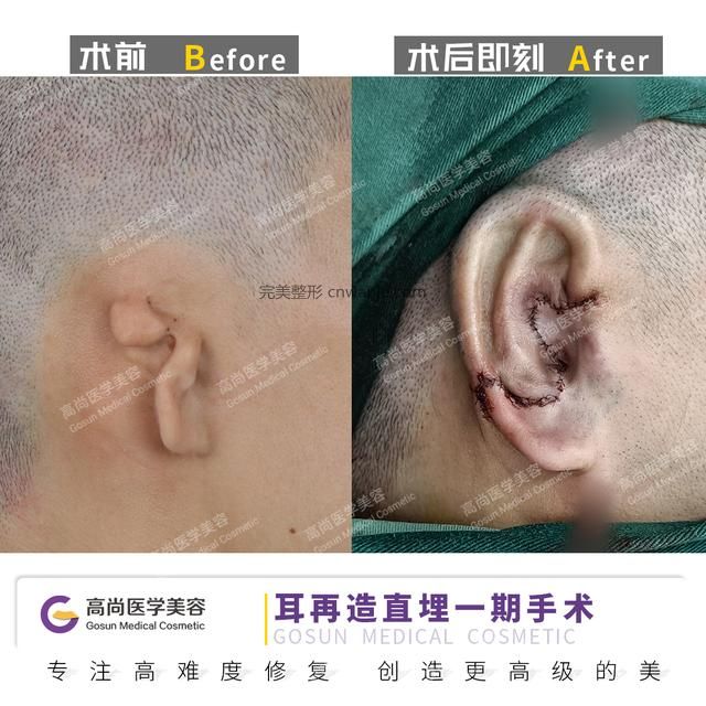 余文林耳再造手术后应该如何保养新耳朵