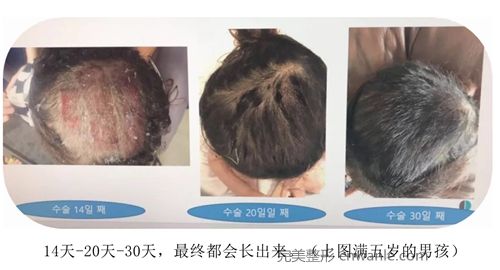 韩国profile普罗菲耳整形医院头皮取皮后恢复