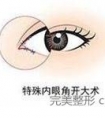 哪些情况需要开眼角?