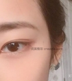 埋线双眼皮好,为什么大家还选择切开式呢?