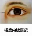 内眦赘皮和开眼角需要同时做吗福州海峡整形视频为您解答