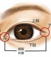 内眦赘皮一定要做手术吗?