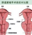 简说阴道紧缩术四大好处