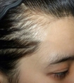 植发际线和纹发际线哪个效果更好?_2