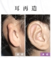 小耳畸形耳再造手术后为什么会肿胀?