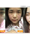 皮秒激光祛斑的后遗症,斑没少几颗脸却更黑,有变化恢复图