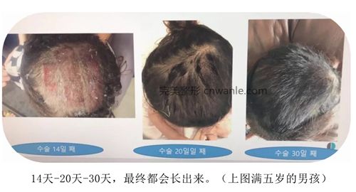 韩国profile普罗菲耳整形医院头皮取皮后恢复