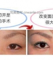 做开眼角手术,眼睛变大是什么体验?