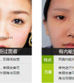 怎样能缩短开眼角手术后的恢复期?