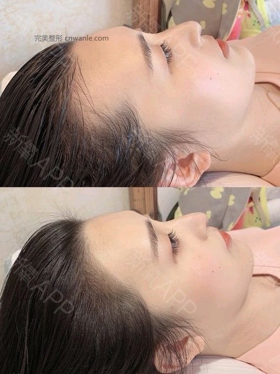 半永久纹发际线 半永久纹发际线