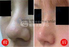 荆州鼻尖整形手术的优点都有哪些呢？
