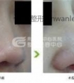 鼻尖整形手术优势有哪些