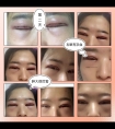 割双眼皮开眼角恢复篇