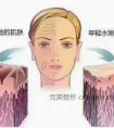 电波拉皮效果如何?会有副作用吗?看过就知道