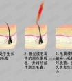 冰点脱毛是什么?冰点脱毛有什么优势 (2)