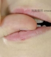 唇部整形应该怎么做 唇部整形需要知道的几点常识