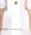 大腿抽脂会反弹吗?有哪些注意事项?