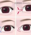 开眼角手术恢复期需要多久?