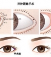 开眼角真的可以使眼睛变大 吗