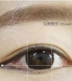 开眼角术后眼睛真的会变大吗