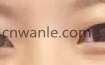全开双眼皮+开眼角 从手术到恢复 详细过程分享
