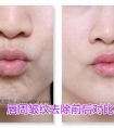 口角纹如何去除