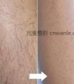 泉州冰点脱毛有哪些优势