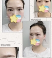 开眼角的疤痕增生期多久后消失?