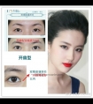 我的内眦赘皮严重吗?想做个双眼皮,需要开眼角嘛。?不开可不可以呢?