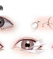 需不需要开眼角?