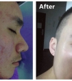 我是如何从满脸痘变成光滑皮肤的丨真人分享,亲测有效