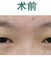 为什么做了双眼皮以后,眼睛会变大很多?