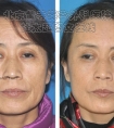 做激光除皱去皱怎么样
